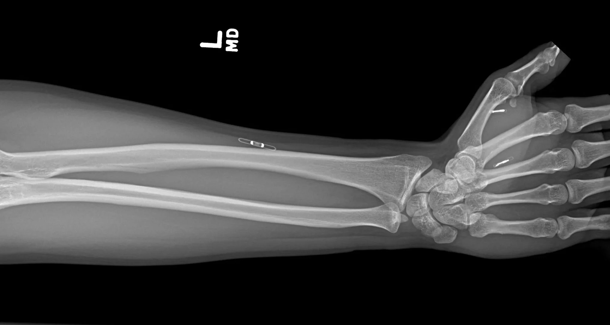 Jack Kingsman&rsquo;s left arm